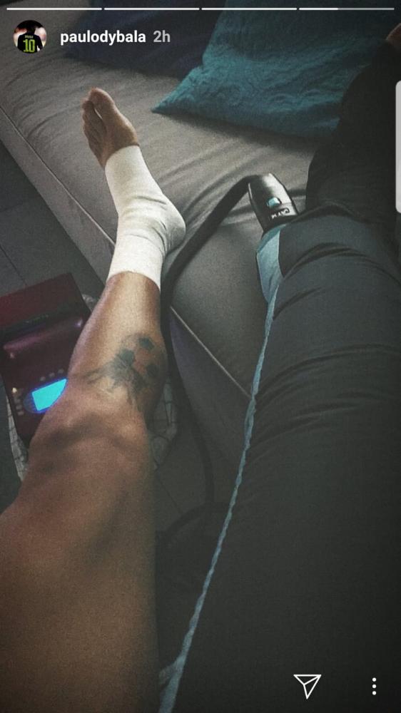 FOTO- La fragile caviglia di Dybala